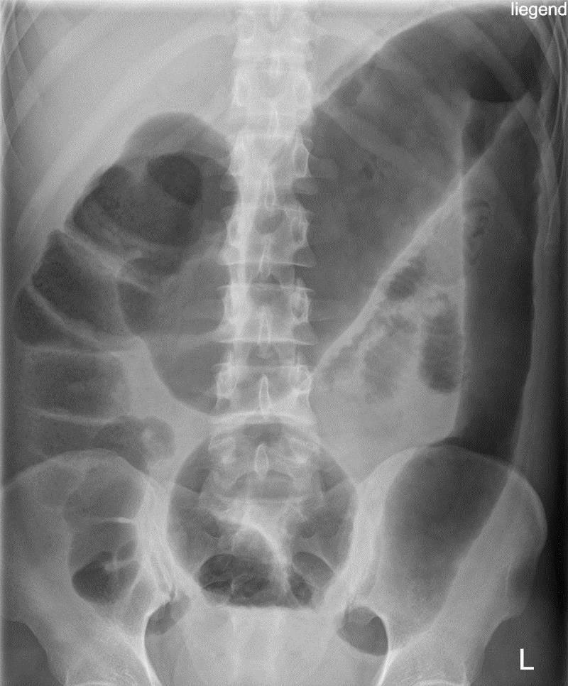 https://upload.wikimedia.org/wikipedia/commons/thumb/d/d3/Toxisches_Megacolon_bei_Colitis_ulcerosa.jpg/800px-Toxisches_Megacolon_bei_Colitis_ulcerosa.jpg