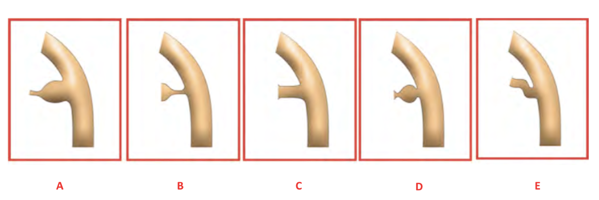 CÒN ỐNG ĐỘNG MẠCH