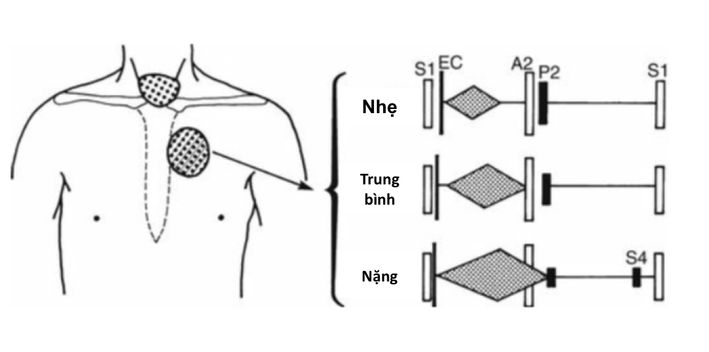 HẸP VAN ĐỘNG MẠCH PHỔI