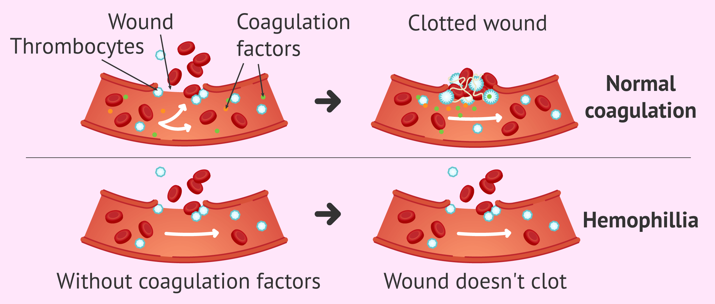 TÓM LƯỢC BÀI GIẢNG HEMOPHIA