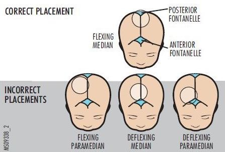 http://acuclinic.com.au/pocit/Vacuum%20-%20Application.jpg