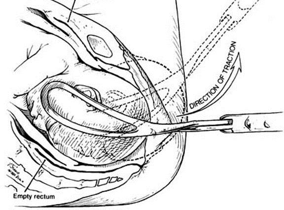 http://intranet.tdmu.edu.ua/data/kafedra/internal/ginecology2/classes_stud/en/med/lik/ptn/Obstetrics%20and%20gynecology/6%20year/04.%20Obstetric%20laceration.files/image028.jpg