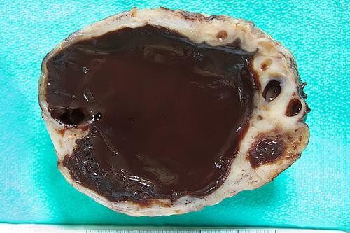 http://www.ovarian-cyst-symptoms.info/images/chocolate%20cyst.jpg