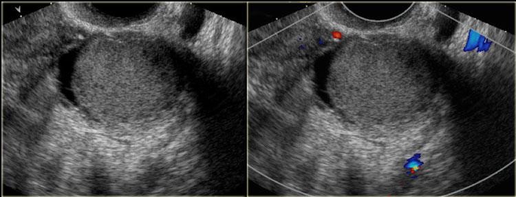 http://www.radiologyassistant.nl/data/bin/a509797a752393_22b-endometrioma.jpg