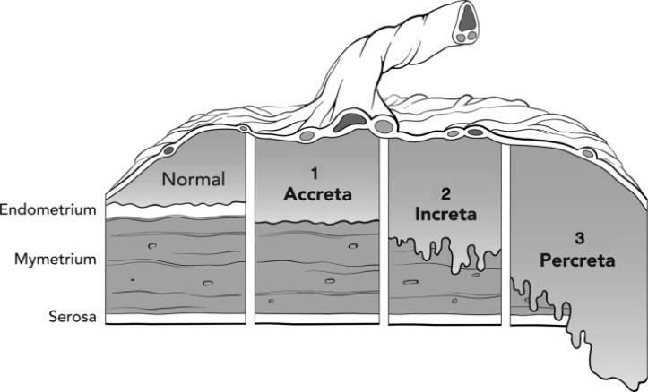 accreta degrees, page2anesthesiology.org.jpg