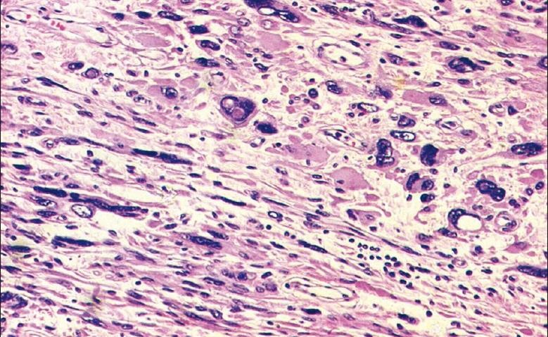 Figure 1: Atypical leiomyoma, marked nuclear pleomorphism and intranuclear inclusions, (Hematoxylin and eosin, ×400)