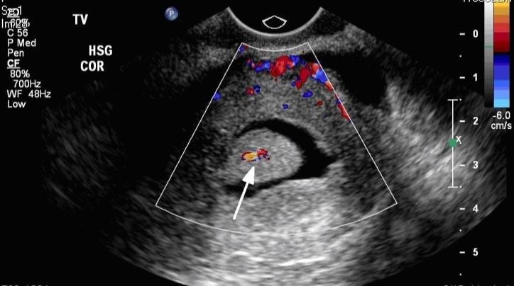 http://dbwmpns0f8ewg.cloudfront.net/images/postmeno/endometrial_polyp.jpg