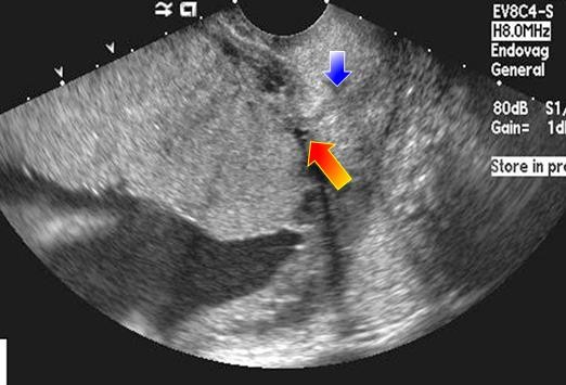 http://img.medscape.com/pi/features/slideshow-slide/alarming-ultrasound/fig4.jpg