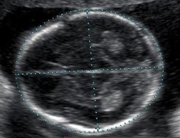 http://www.ultrasoundpaedia.com/uploads/53003/ufiles/Second_Trimester/Normal/2nd%20Trimester%20Normal/bpd-and-hc.jpg