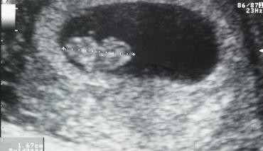 https://upload.wikimedia.org/wikipedia/commons/3/32/Ultrasound_of_human_fetus,_8_weeks_and_1_day.jpg