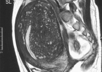 Kết quả hình ảnh cho adenomyosis MRI