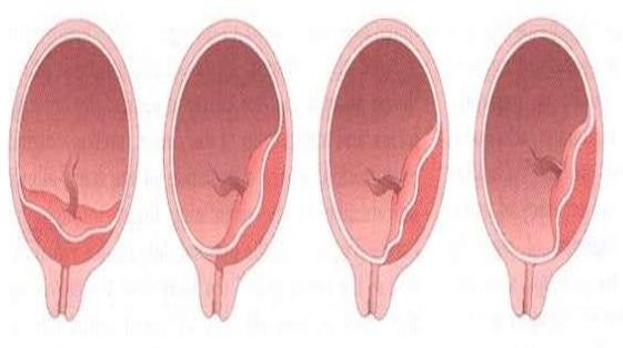 placenta-previa-2-638.jpg