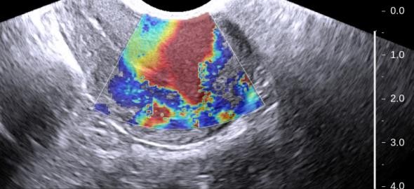 Résultat de recherche d'images pour "adenomyosis elastography"