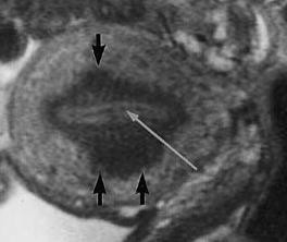 Résultat de recherche d'images pour "adenomyosis JZ MRI"