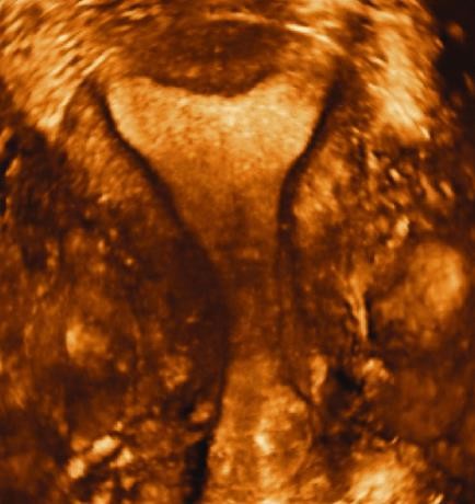 Résultat de recherche d'images pour "junctional zone uterus ultrasound"