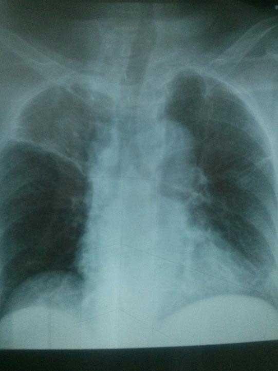 X- quang tim phổi